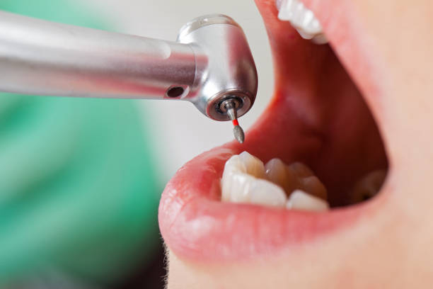 Best Emergency Treatment for Dental Infections or Abscesses in Toledo, IL